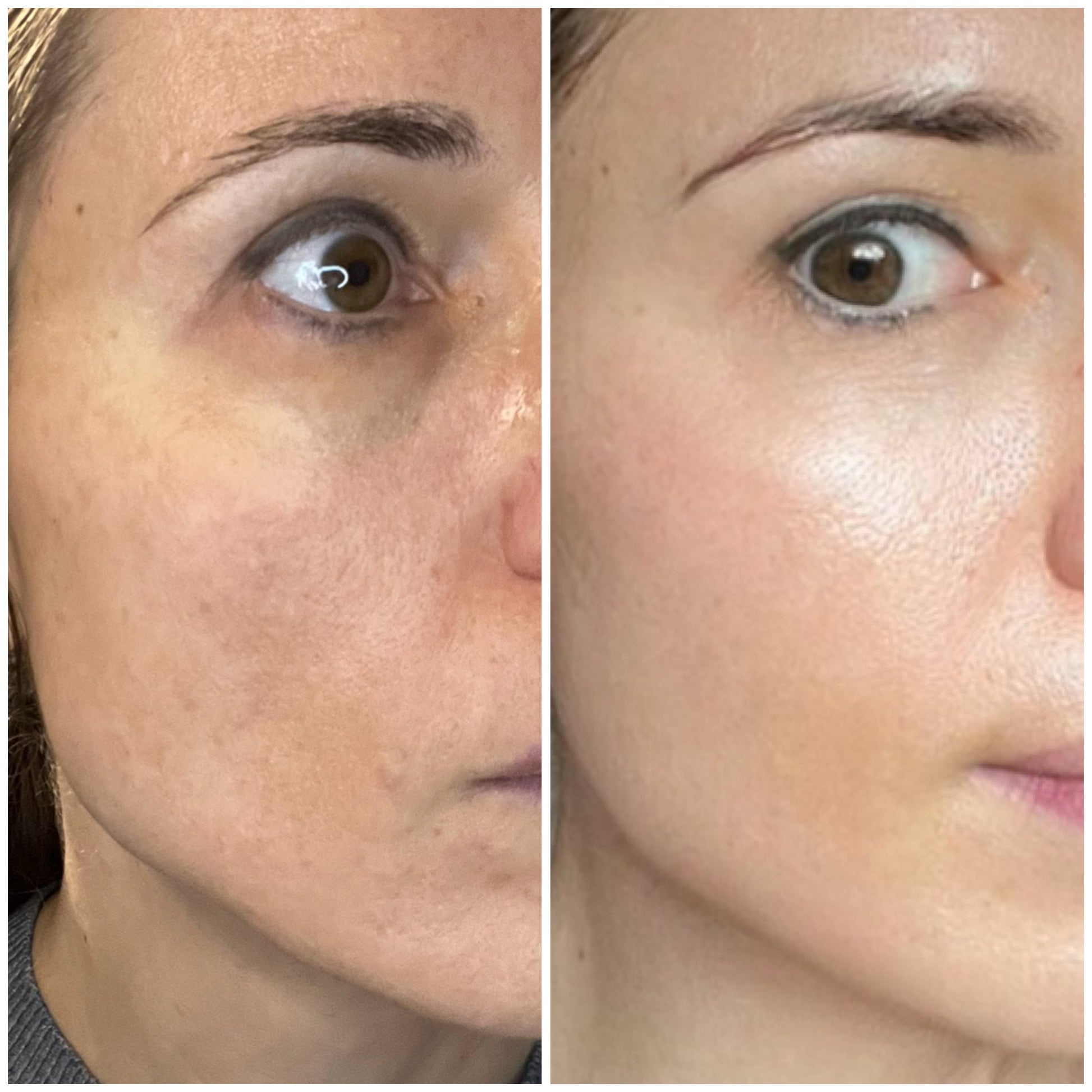 ANTI-AGING PROMO Micro Infusion Treatment 1 single - use