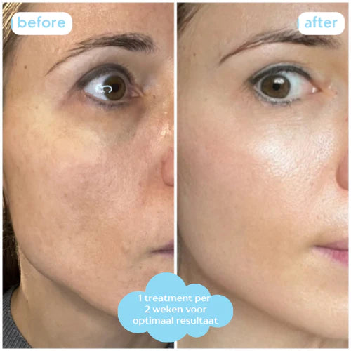 Hydrating Micro Infusion Treatment 1 maand